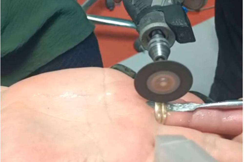 Batman'da parmağa sıkışan y&uuml;z&uuml;ğe itfaiye m&uuml;dahalesi